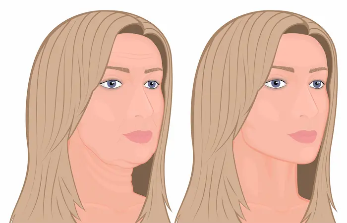 cosmetic Surgery